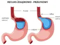 Ilustracja pokazuje refluks żołądkowo-przełykowy. Po lewej zamknięty zwieracz, po prawej otwarty, powodujący cofanie się treści żołądkowej do przełyku. Kawa może nasilać ten problem.