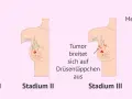 Illustrationen zeigen Stadien von Brustkrebs. Frühe Symptome wie ein Tumor werden sichtbar, bevor er sich ausbreitet. Spätere Stadien zeigen Metastasen.