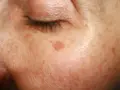 Haut mit Altersflecken. Ab wann diese auftreten, ist individuell. Hier eine Nahaufnahme der Haut mit Pigmentflecken.