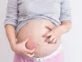 Kobieta w ciąży drapie brzuch z powodu swędzenia skóry.