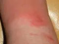 Pelle arrossata e infiammata sulla gamba, con segni di erisipela.