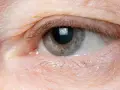 Occhio con palpebra leggermente gonfia, segno di edema oculare da stress. La pelle appare stanca, con sottili rughe e qualche ciglia spezzata.