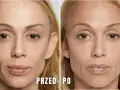Przed i po zabiegu: wygładzenie skóry pod oczami dzięki kwasowi polimlekowemu. Skóra wygląda na bardziej napiętą i odmłodzoną.