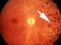 Retinite pigmentosa: sintomi visibili come depositi scuri sulla retina, indicati da una freccia bianca.