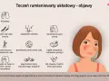 Ilustracja przedstawia objawy tocznia rumieniowatego układowego: ból głowy, obrzęki, wypadanie włosów, owrzodzenia, gorączkę, utratę wagi, zmęczenie, wysypkę motylkową, problemy ze wzrokiem i bóle stawów.