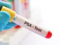 Blauer Handschuh hält Röhrchen für PSA-Test. Der PSA-Wert ist normal, was für die Gesundheit spricht.