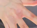 Rote, trockene Haut mit schuppigen Stellen an der Hand, ein deutliches Ekzem.