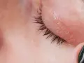 Nahaufnahme eines Auges mit roten Augenlidern, die auf eine Mangelerscheinung hindeuten. Eine dunkle Nagelspitze berührt sanft die Haut.