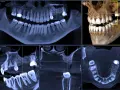 Badanie CBCT zębów: panorama, przekroje i wizualizacja 3D szczęki. Widoczne ubytki i korony.