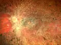 Retina con pigmentazione irregolare e vasi sanguigni, indicativa di amaurosi congenita di Leber. Ricerca di nuove cure in corso.