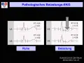 Vergleich von EKG-Aufzeichnungen in Ruhe und unter Belastung. Das Belastungs-EKG zeigt eine ST-Senkung, was auf pathologische Veränderungen hinweist.