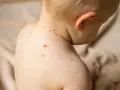 Dziecko z ospą, czerwone kropki na skórze. Jak długo w domu?