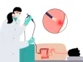 Arzt führt Darmspiegelung durch. Eine Lupe zeigt eine Entzündung im Darm. Warum nicht duschen vor Darmspiegelung? Hygiene ist wichtig.