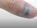 Gros plan sur un pouce avec un ongle bleu, signe d'un choc ou d'une ecchymose sous l'ongle.