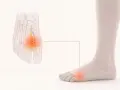 Illustration av en fot med markerad smärta i framfoten, relaterat till plantar fasciit.