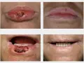 Prima e dopo il trattamento di una lesione labiale. Non si tratta di schiacciare punti neri sulle labbra, ma di una cura medica.