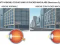 Confronto tra visione normale e pucker maculare, con illustrazioni di edifici e occhi. La terapia farmacologica è una delle opzioni.