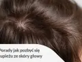 Łupież na skórze głowy, spowodowany przez Malassezia. Domowe sposoby na jego zwalczanie.