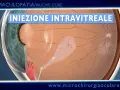 Iniezione intravitreale per trattare la maculopatia atrofica, mostrando una lesione sulla retina.