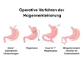 Illustrationen zeigen operative Verfahren zur Magenverkleinerung, darunter ein Magenbypass.