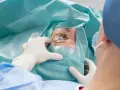 Chirurg w rękawiczkach przygotowuje oko pacjenta do zabiegu laserowej korekcji wzroku.