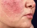 Nahaufnahme eines Gesichts mit roten, trockenen Flecken und Pusteln auf der Wange.
