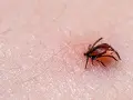 Makro zbliżenie na kleszcza wbitego w ludzką skórę, widoczne drobne włoski i tekstura naskórka.