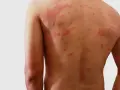 Plecy mężczyzny pokryte czerwonymi, swędzącymi zmianami skórnymi, przypominającymi ziarniak obrączkowaty.