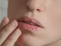 Nahaufnahme von trockenen, rissigen Lippen, die nach Feuchtigkeit verlangen.