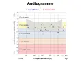 Audiogramme montrant les résultats d'un test auditif. Les zones indiquent le niveau de perte auditive, de "Pas de perte" à "Perte profonde", en fonction de la fréquence et de l'intensité sonore. Ce graphique est essentiel pour évaluer l'audition à tout...