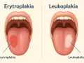 Dwa otwarte usta z językami: jeden z czerwoną plamą (erytroplakia), drugi z białą (leukoplakia).