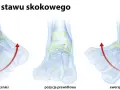 Ilustracja pokazuje inwersję stopy, czyli odwrócenie, które prowadzi do uszkodzenia więzadła skokowo-strzałkowego. Obok prawidłowa pozycja i ewersja.