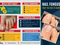 Infographie sur le vernis mycose : causes, symptômes, prévention et traitements. Avant/après montrant l'amélioration d'un ongle atteint.