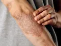 Psoriasis en los codos, con parches escamosos y enrojecidos. Una mano toca suavemente la piel afectada.