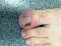 Gros plan sur un ongle de pied présentant un problème d'infection fongique, avec une partie de l'ongle décolorée et abîmée.