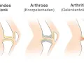 Vergleich von Gelenken: gesund, Arthrose (Knorpelschaden) und Arthritis (Gelenkentzündung). Arthritis zeigt eine Entzündung im Gelenk.
