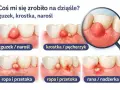Guzki, krostki, ropnie i rany na dziąsłach. Moje zęby i dziąsła bolą, potrzebuję pomocy dentysty.