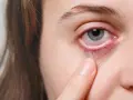 Occhi rossi e lacrimanti, forse per un'allergia o stanchezza. Un dito sfiora la palpebra inferiore, evidenziando il disagio.
