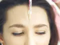 Una jeringa con aguja fina se acerca a la frente de una mujer, mostrando el procedimiento de **que es el botox** para suavizar arrugas.