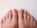 Gros plan sur des pieds, dont un ongle d'orteil atteint d'une mycose, illustrant un problème d'entretien ongles pieds.