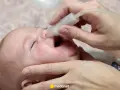 Oczyszczanie noska niemowlaka z wydzieliny, która może być przyczyną mokrego kaszlu.