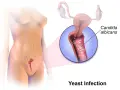 Illustration of a yeast infection in the vagina, showing Candida albicans.