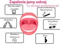 Skuteczne płukanki na stan zapalny jamy ustnej, które przynoszą ulgę