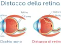 Confronto tra occhio sano e occhio con distacco della retina, mostrando la rottura e il sollevamento della retina.