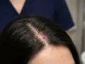 Lesiones rojas y elevadas en el cuero cabelludo, indicativas de foliculitis.