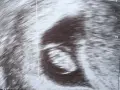 Ultraschallbild zeigt einen frühen Embryo. Die Ramzi-Methode könnte hier angewendet werden, um das Geschlecht zu erraten.