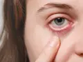 Sjögren Syndrom Diagnostik: Symptome, Tests und häufige Herausforderungen