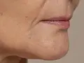 Primer plano de la zona de la barbilla y boca, mostrando la flacidez facial a los 40 y algunas pecas.