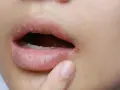 Zajady przy ustach mogą świadczyć o niedoborze witaminy B2. Zobacz, jak wyglądają.