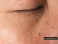 Primer plano de la piel del rostro con varias verrugas, mostrando la textura y el detalle de la piel. La imagen sugiere la necesidad de quitar verrugas cara.